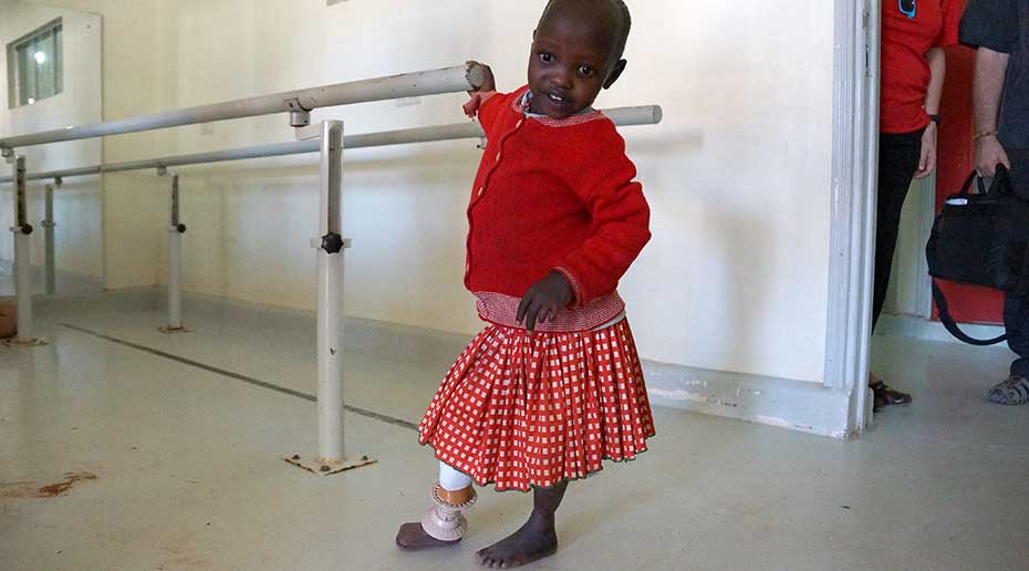 A child with a prosthetic right leg holding onto a metal bar.